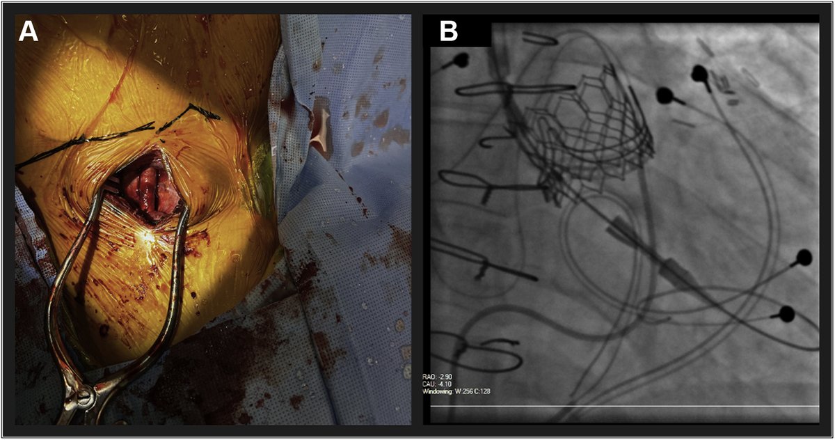 JACCJournals's tweet photo. #JACCCaseReports #WednesdayAnswer: B
After #HeartTeam discussion at comprehensive #HeartValveCenter, ViV #TAVR in SAV was successfully performed considering the high-risk redo-surgery, providing the patient w/ a valuable alternative to #HeartTx. https://t.co/AsTxBuZr6g #CHD https://t.co/3S4tstpaym