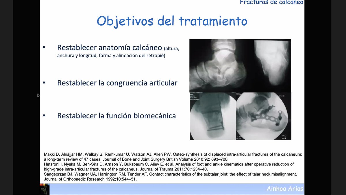 cot_csi's tweet photo. La Dra. Ainhoa Arias desde Centro de Prevencion y Rehabilitacion de ASEPEYO en Sant Cugat, comienza hablando sobre “#Fracturas de #calcaneo” @Asepeyo #altaenergia #TC #3D #CEPRA #Sanders #percutaneo #MIPO #Broden https://t.co/3tEHG2iG7i
