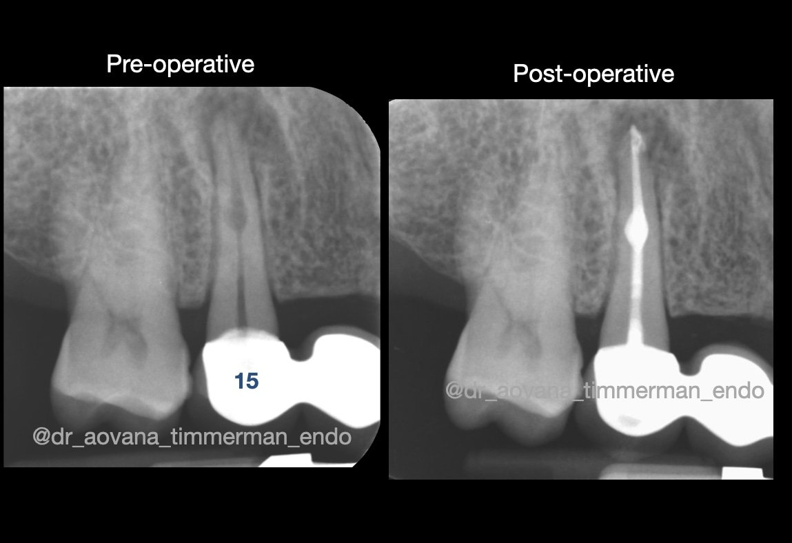 Dr_A_Timmerman's tweet photo. Nice to help a lovely patient out with a tooth presenting with internal #intraradicular inflammatory #root #resorption, it's rather rare to see this. #endodontics #endodontist #rootresorption #dentist #dentistry #melbourne https://t.co/0Fuakq9xgu