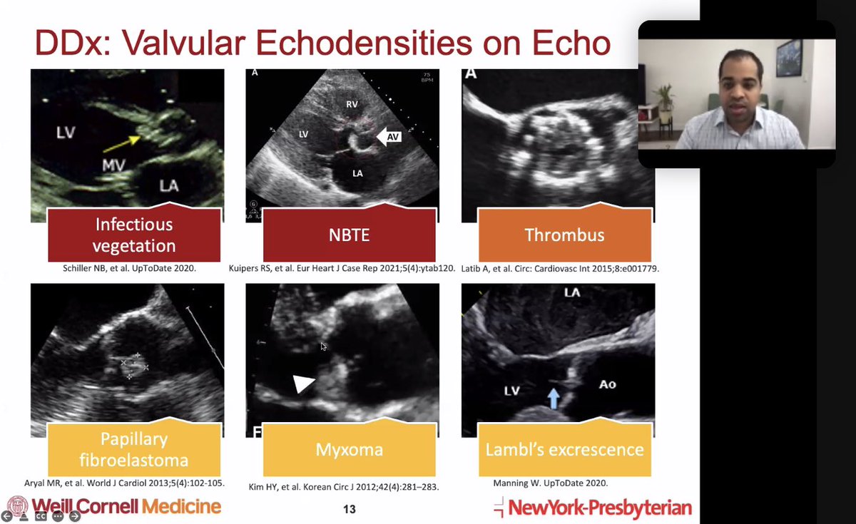 Weill Cornell Cardiology Fellowship (@wcmcardsfellows) on Twitter photo Clinical Case Conference with first-year fellow <a href="/nickysinghmd/">Nicky Singh</a> on an interesting case of endocarditis complicated by STEMI. Great imaging review of differentiating valvular densities on echocardiogram below. #EchoFirst #Cardiotwitter Clinical Case Conference with first-year fellow <a href="/nickysinghmd/">Nicky Singh</a> on an interesting case of endocarditis complicated by STEMI. Great imaging review of differentiating valvular densities on echocardiogram below. #EchoFirst #Cardiotwitter