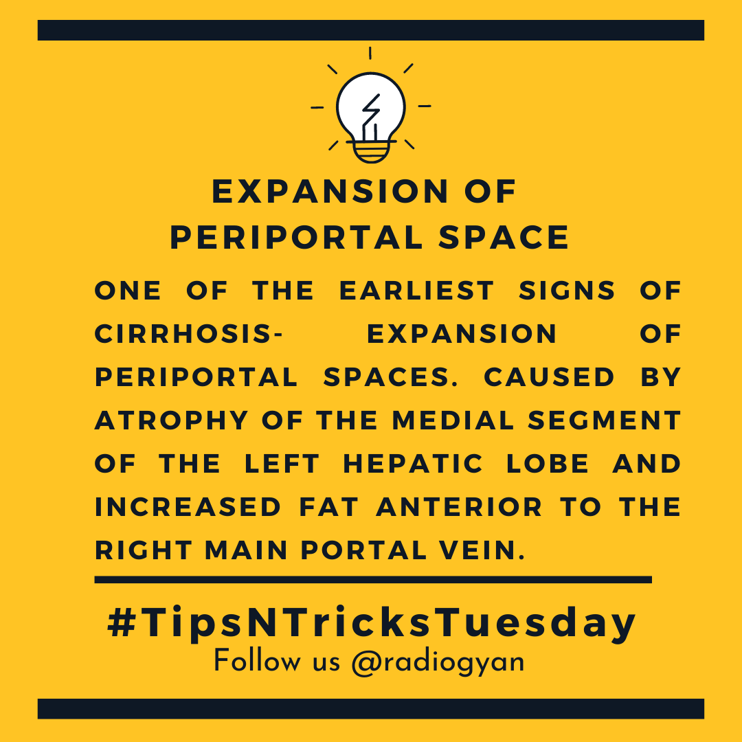 TeamRadioGyan's tweet image. #TipsnTricksTuesday

Here is a pearl about expansion of periportal space. 
 
All credits to #TeamGyan member Dr. Dev.
Follow him on Instagram @drdevrad for more.
 
#radiogyan #studygram #study #learning #radiology #periportal #radres #foamrad