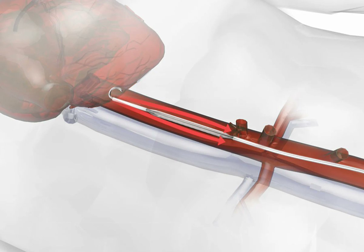 EVAC Fact No. 2️⃣ // It features a single-use aortic balloon catheter that can be used in any #criticalcare setting by inserting it through the femoral artery into the aorta. Learn what makes it special 👉buff.ly/3stILLC