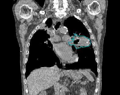 Vancouver Radiation Medicine tweet media