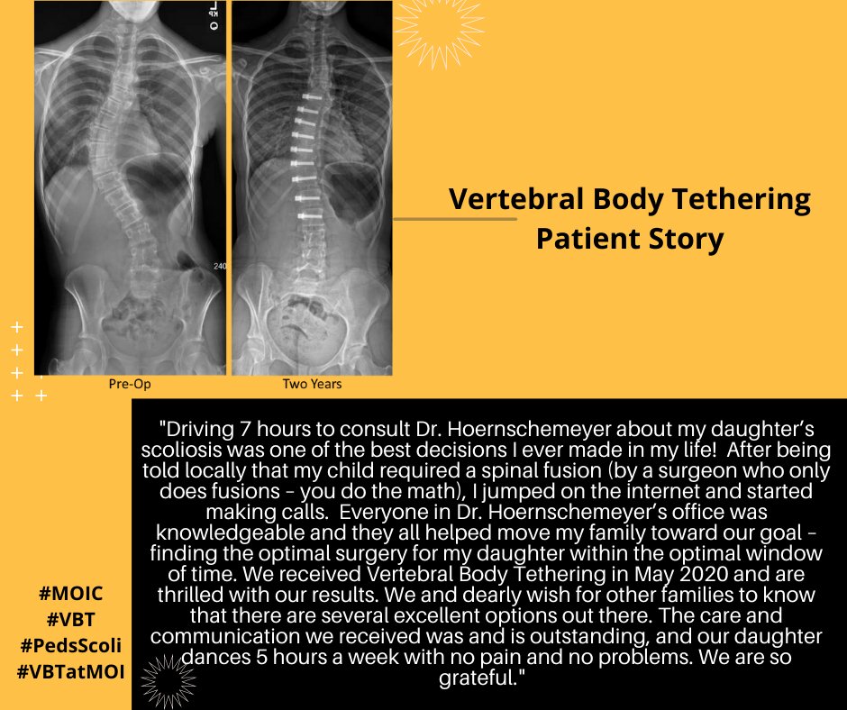 Check Out This Patient Story! M-I-Z V-B-T #evidencebasedmedicine #patientcentred #vertebralbodytethering @MUOrthopaedic