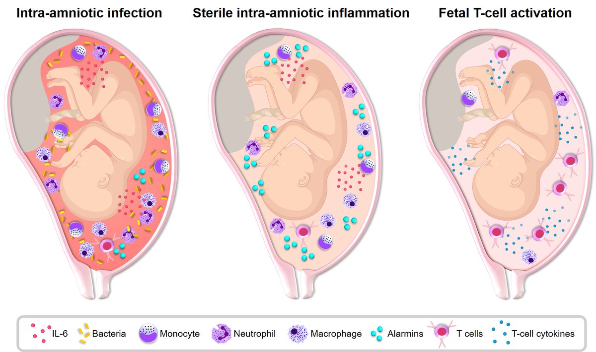 Would you like to learn more about the immunobiology of preterm labor and birth? Click here: doi.org/10.1530/REP-22… #PRBteam 
@NICHD_NIH <a href="/waynemedicine/">Wayne State University School of Medicine</a> @i_am_intramural <a href="/ReprodJournal/">Reproduction journal</a> @SRF_Repro <a href="/ISImmunolReprod/">ISIR</a> <a href="/ASReproImmuno/">ASRI</a> <a href="/SRIWomensHealth/">SRI</a> <a href="/IFPA_Official/">IFPA</a> 
<a href="/PerinatResSoc/">Perinatal Research Society</a>