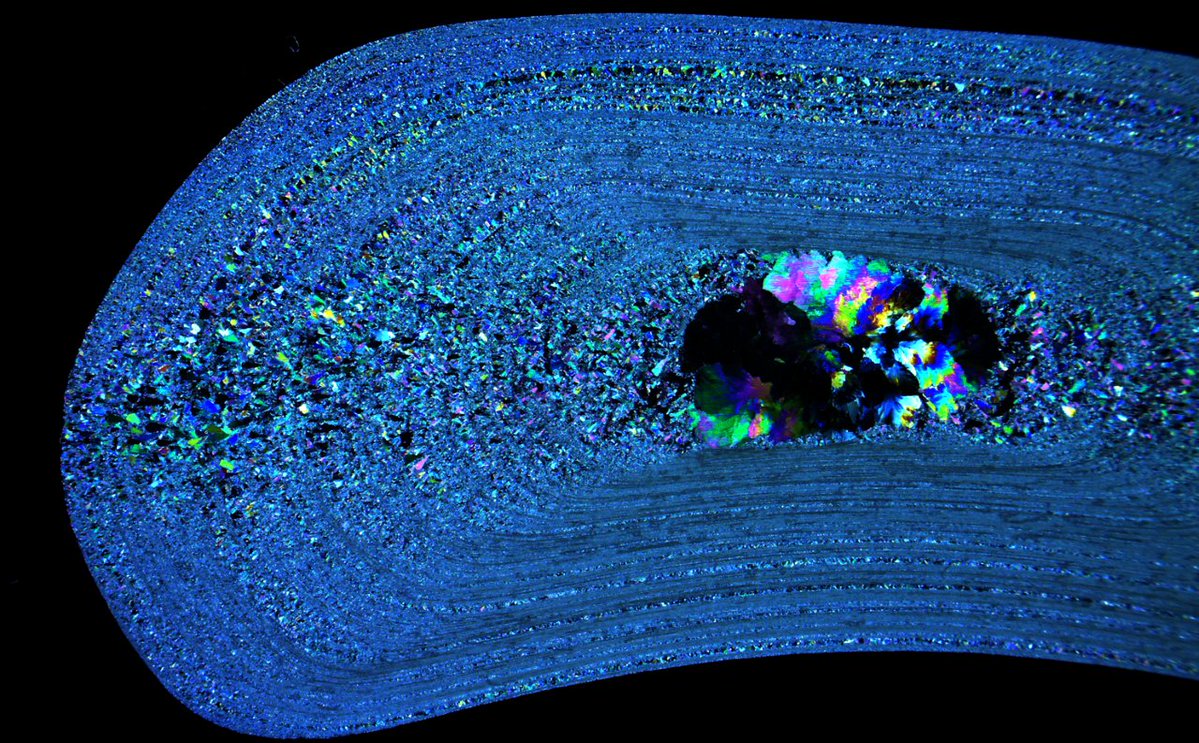 Shekhar Biyani (@shekharbiyani) on Twitter photo Never thought that stones could look so amazing. Ben (research fellow) <a href="/UoLStudents/">Uni Leeds Students</a> said "Beauty behind the pain!" Andrew and Antonia, School of Chemical& ProcessEngineering <a href="/UniversityLeeds/">University of Leeds</a> used SEM images. What is the chemical composition of this urinary stone? <a href="/BAUSendourology/">BAUS Endourology</a> Never thought that stones could look so amazing. Ben (research fellow) <a href="/UoLStudents/">Uni Leeds Students</a> said "Beauty behind the pain!" Andrew and Antonia, School of Chemical& ProcessEngineering <a href="/UniversityLeeds/">University of Leeds</a> used SEM images. What is the chemical composition of this urinary stone? <a href="/BAUSendourology/">BAUS Endourology</a>