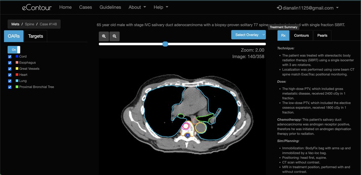 eContourRadOnc's tweet image. 📢 NEW case from 🌟 resident @yazshaz and the @MayoRadOnc Rochester #radonc team now LIVE on #eContour ‼️

👀 this 🔥 spine SBRT case: econtour.org/cases/148!

@ARRO_org @ACROresident @ACRORadOnc #MedEd