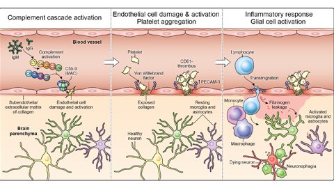 Brain1878's tweet photo. Lee et al. examine microvascular pathology in the brains of patients who died from COVID-19. They show that antibody-mediated cytotoxicity directed against brain endothelial cells is likely to be the initiating event that leads to neurovascular injury. https://t.co/VL6YqMh20p https://t.co/CjvG02WNNi