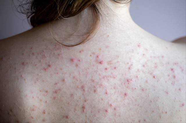 treatment untuk mengatasi jerawat punggung

a thread