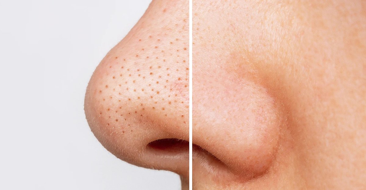 shopwithdiyan's tweet photo. Haritu ada this one guy share routine dia untuk hilangkan blackhead. Dia cakap tak susah pun nak hilangkan blackhead, pakai je cleanser yang ada salicylic acid. 

So, I pun try la this cleanser, and suprisingly memang kurang weh. Hidung I sebelum ni rasa biji biji tu dah takda😭 https://t.co/8CADLeZyB6