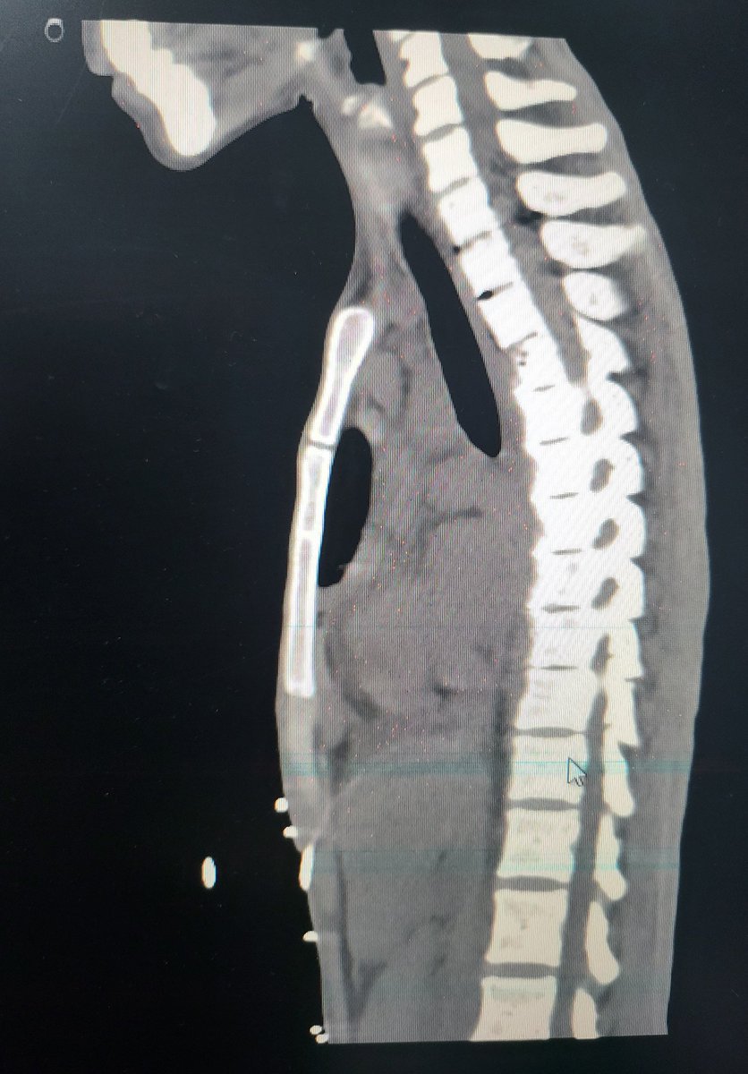 DrDeepakKrishn1's tweet photo. CT chest confirmed findings consistent with tuberculosis of lungs with involvement of spine. I had a suspicion on spine because she had quite a bit of back pain when we were moving her in the cath lab. #PottsSpine https://t.co/w07Asd8FWi