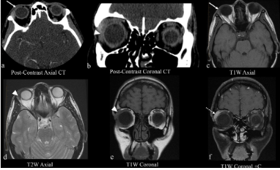 BJR_Radiology's tweet photo. Pictorial review
The forgotten lacrimal gland and lacrimal drainage apparatus: pictorial review of CT and MRI findings and differential diagnosis
https://t.co/pByAZ3rQei
#Radiology #CT #MRI https://t.co/vLvdkk7uCA