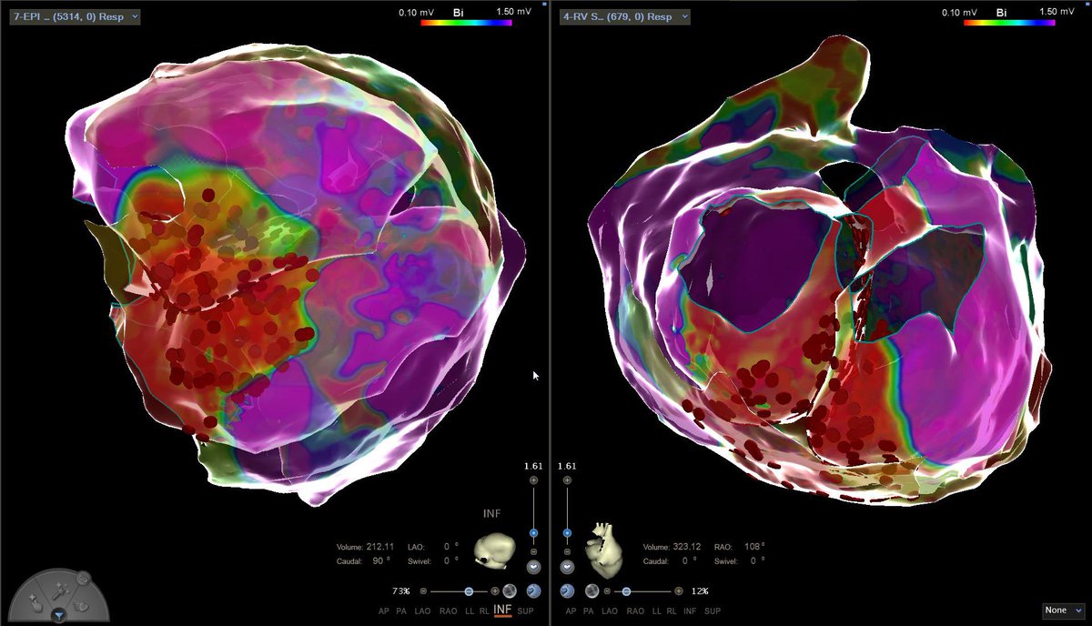 chris_sohns's tweet image. Septum modification in #VTach patient with sarcoidosis using the #Q4U VT workflow😉 ⁦@HdzNrw⁩ #Epeeps #das_cam_2021 ⁦@Phiso_de⁩ ⁦@johncamm⁩ ⁦@ChristianHeeger⁩ ⁦@AGEP_DGK⁩ ⁦@AndreasMetzner7⁩ ⁦@Dominik_Linz⁩ ⁦@DrKollias⁩
