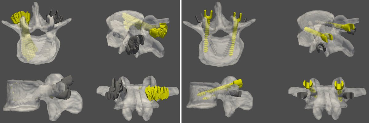 TheJNS's tweet photo. #NeurosurgicalFocus A novel surgical planning system using an AI model to optimize planning of pedicle screw trajectories with highest bone mineral density and strongest pull-out force

https://t.co/RFyLhIf1Gw https://t.co/9CzdWI9bfb