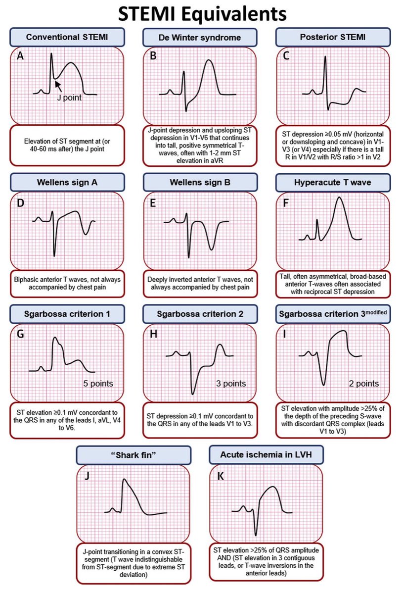 BrownJHM's tweet photo. STEMI equivalents @patrickching #BJHM #ECG #FOAMed #MedEd #STEMI #MedTwitter #Medstudent #TipsForNewDocs #ACS https://t.co/HeVwRWw4na