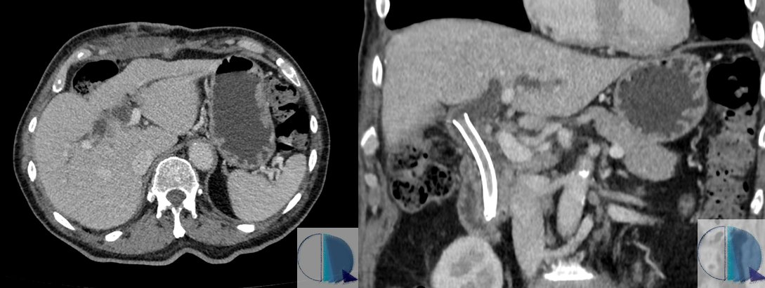 Hey there! Not everything is cardiac imaging at <a href="/RMyTC_Rosario/">RM y TC Rosario</a>. This is the case of an 80yo patient with a history of cholecystectomy and stent placement in the common bile duct due to chronic obstruction, who presented with right flank pain and elevated bilirrubin. 1/6
