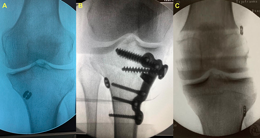 DovePress's tweet photo. Meniscal Root Repair Alone or Combined with Different Procedures After at Least 6 Months of Follow-Up: A Series of Cases
👇
https://t.co/0UHyKfXw0f

Published in the Open Access Journal of Sports Medicine
https://t.co/yDleIOEB8a

#MeniscalRootRepair #SportsMedicine #Transtibial https://t.co/RfLMe74RTi