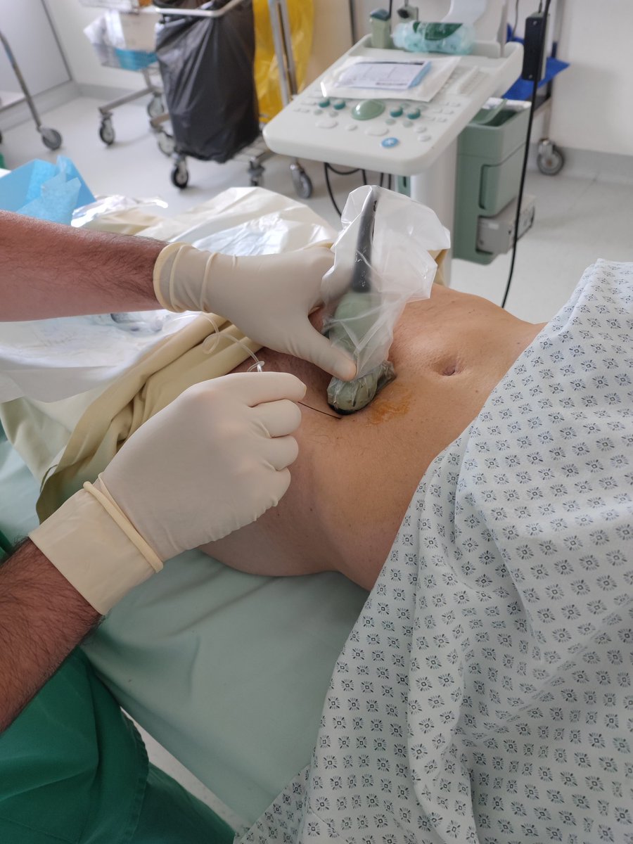 #rectussheathblock
#prostatectomy
As effective as usual Rectus sheath block for radical prodtatectomy in a MMA strategy 😉