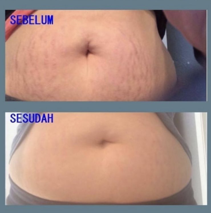 explorefemale's tweet image. Penyebab Stretch Mark dan Cara Menghilangkannya✨

Stretch mark sebenarnya bagian dari proses alami perubahan kulit. Melansir Healthline, stretch mark di kulit bisa muncul ketika lapisan tengah kulit terlalu meregang.

Semoga thread ini bisa membantu kalian🤗🤗

-a thread-