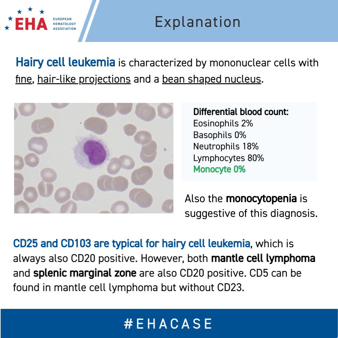 EHA_Hematology's tweet photo. Good morning!👋The answers are #Hairycellleukemia, #CD25 and #CD103. You can find out why below. We hope you enjoyed this week’s double question #EHACase. Thanks for joining and see you in the next case! https://t.co/i8LzawvhIF