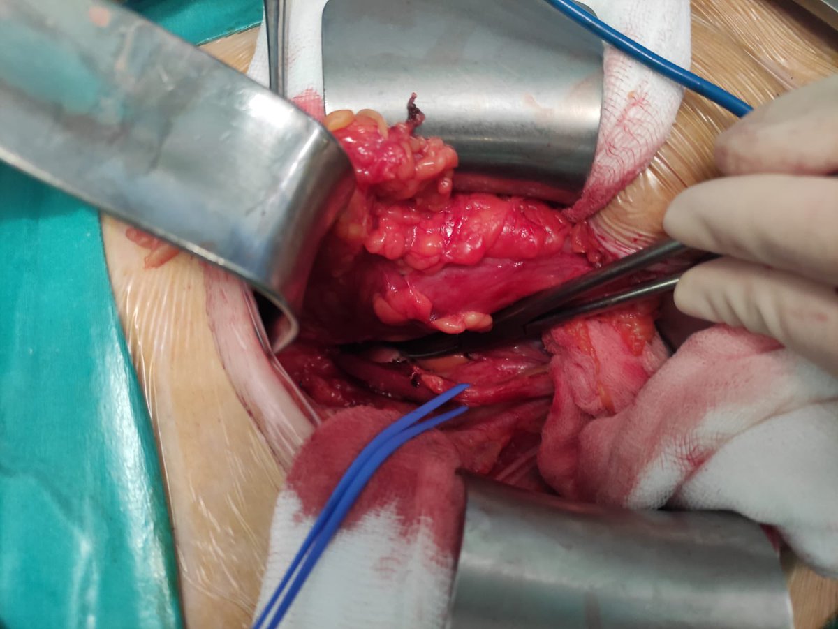 Emiliojemma's tweet photo. 37 yo women with left iatrogenic ureteral section during histerectomy. Extravesical Lich-Gregoire ureteral reimplant as an excellent option @SaludNorteMalag #urology #UroSoMe #surgery https://t.co/PuicMDgZNy