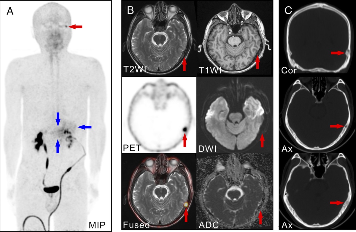 ClinNuclearMed's tweet image. Current Issue: Fibrous Dysplasia Mimicking Skeletal Metastasis on 68Ga-FAPI PET Imaging dlvr.it/STN0Dh