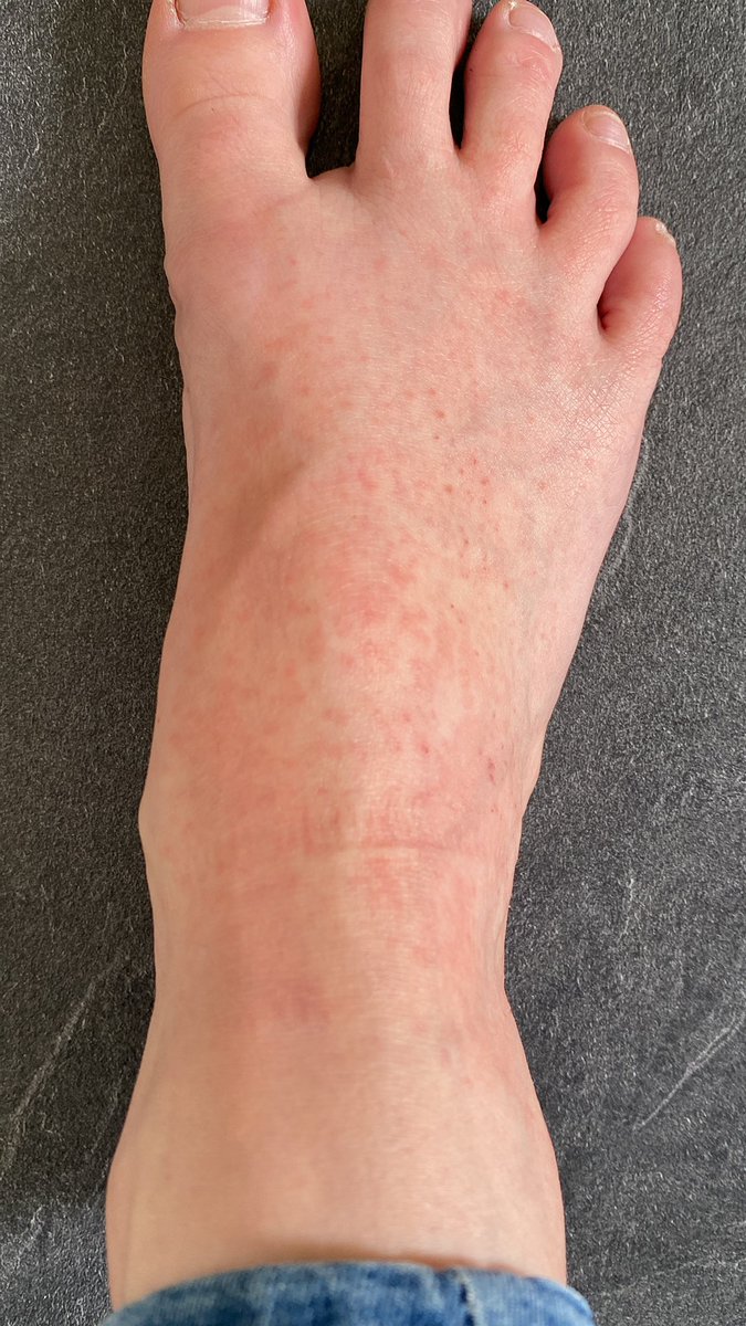 melhugs88's tweet photo. @superdrug I used one of your £8.99 foot peel masks two days ago, the top of my foot is now extremely itchy and sore. Nothing else about my routine has changed… this definitely needs to be on the pack as a warning! #footpeel #ouch #itchy! https://t.co/CrMsttTPps