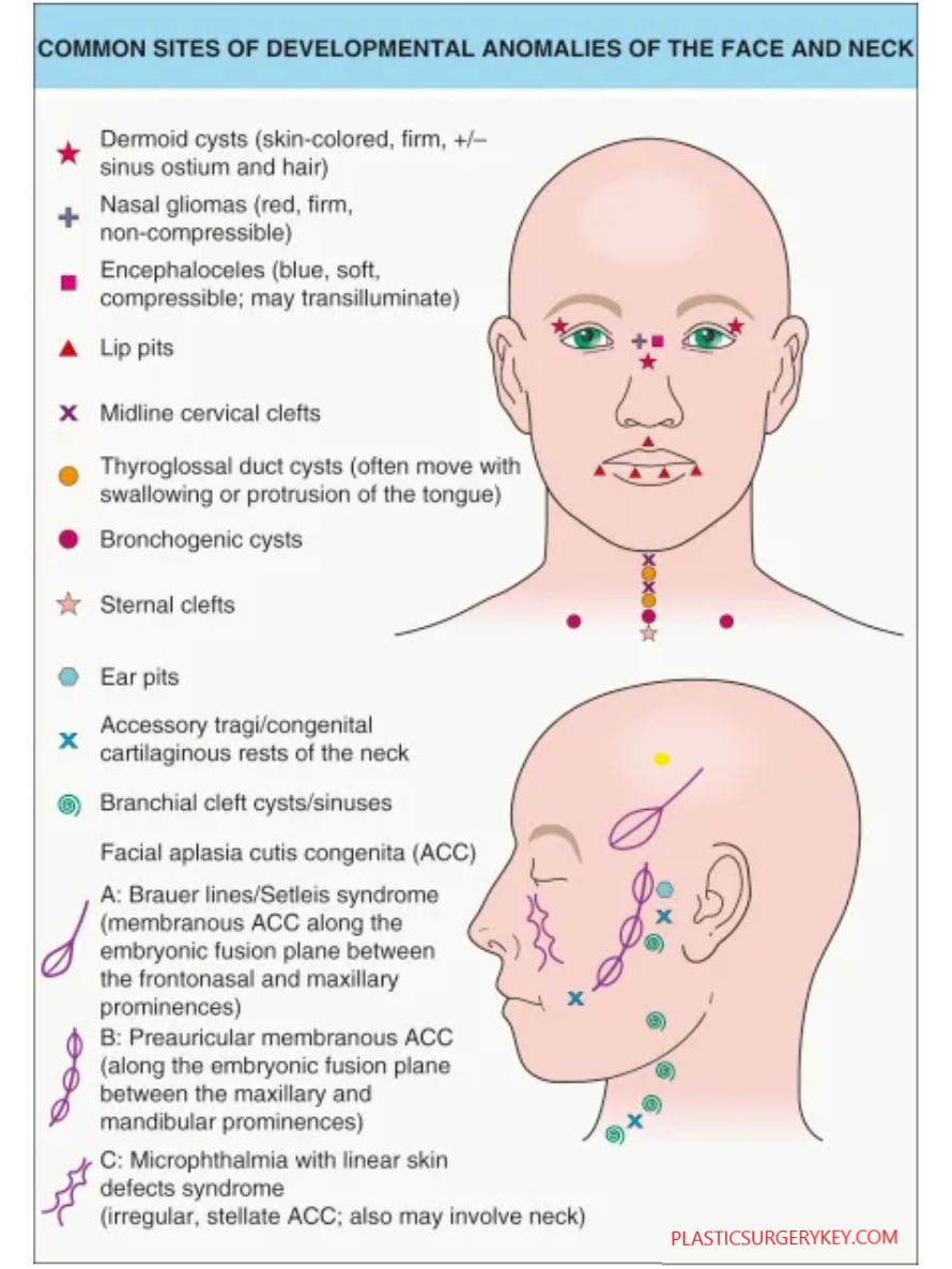 martiponi's tweet photo. #DermoidCyst bening cutaneous developmental anomaly that arises from the entrapment of ectodermal elements along the lines of embryonic closure
This is an example in the eyebrow tail ๐คช
#pedipath #basicpath https://t.co/NshqhGbzhp