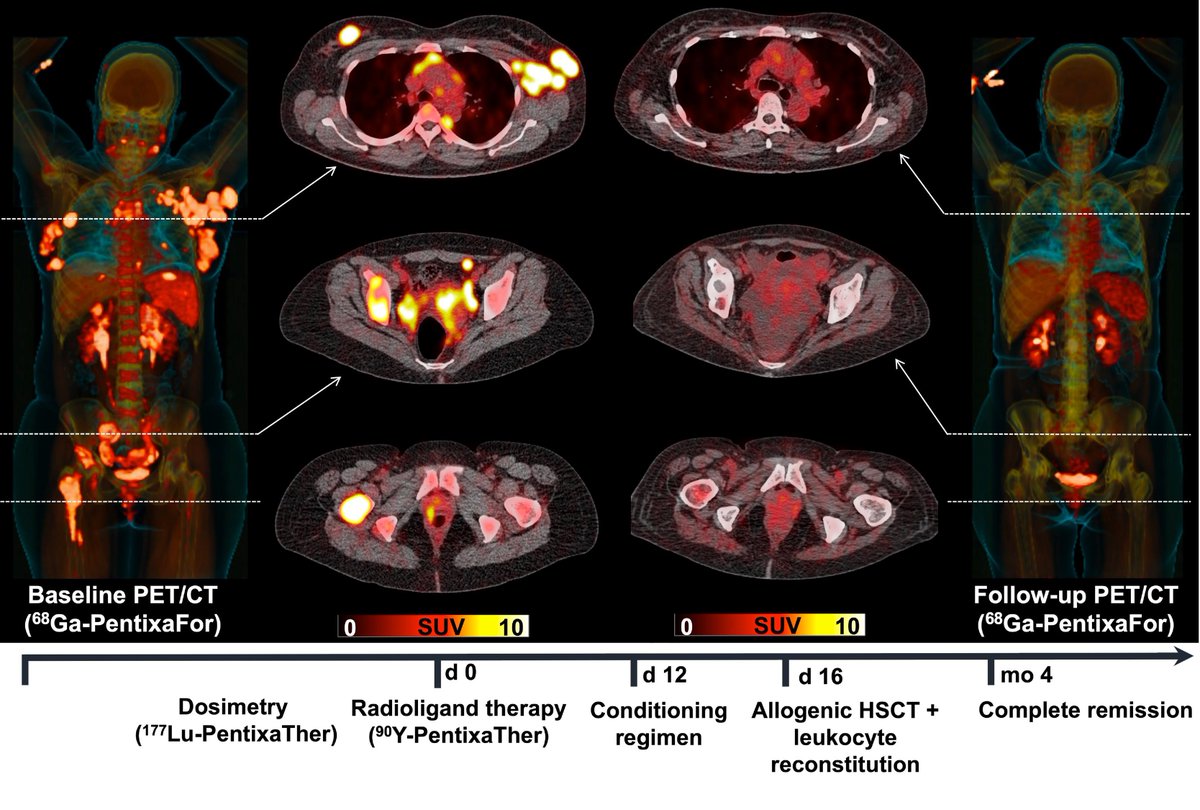 JNM (@journalofnucmed) on Twitter photo Targeting CXCR4: Another promising theranostic approach. ow.ly/ovOx50JJQNa 
#PersonalizedMedicine #NuclearMedicine #Lymphoma Targeting CXCR4: Another promising theranostic approach. ow.ly/ovOx50JJQNa 
#PersonalizedMedicine #NuclearMedicine #Lymphoma