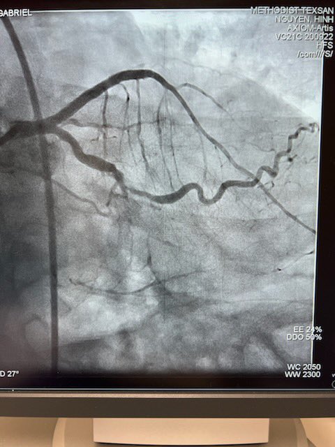 KeithNguyenSAIF's tweet photo. Double cto intervention lcx and rca.  Ef 40%. @SAIFSanAntonio https://t.co/xswxuNxUyN