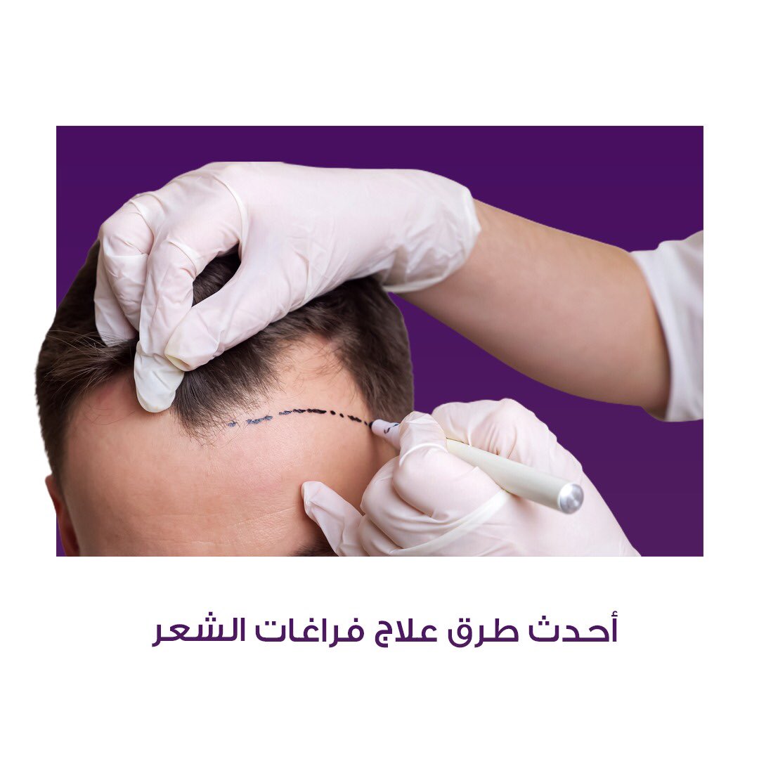 Juva_ht's tweet photo. للإستفسار يُرجى التواصل معنا عبر أرقام الإتصال أو عبر الواتس أب 🌺

📍الرياض ، شارع التخصصي
0114809666 أو 0539809666

#جوفا
#جمال_يتجدد 💜🤩

#الرياض #زراعة_الشعر_في_تركيا #زراعة #زراعةالشعر #زراعة_الشعر #زراعة_الشعر_في_اسطنبول #زراعة_شعر https://t.co/JmD0OK6TNf