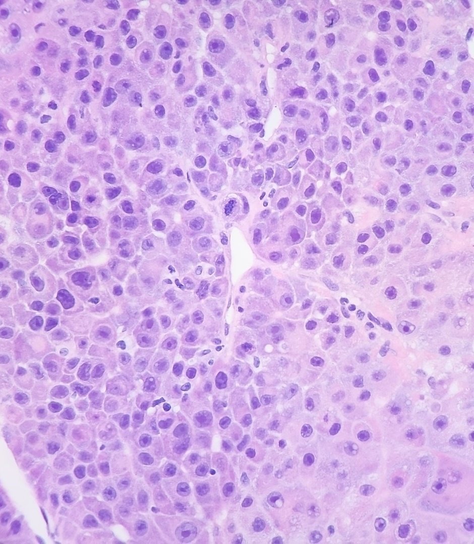 Lung biopsy.

#pathology #PathTwitter #pathmatch22 #pathmatch23