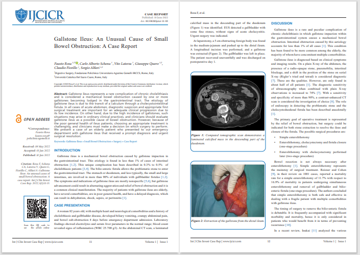 ijcicr's tweet photo. **** New Publication ****
#Gallstone Ileus: An Unusual Cause of Small Bowel Obstruction.
DOI - 10.55828/ijcicr-11-03
Click to read full article - https://t.co/x7QdpzeNmD
#casereports #gallstones #gastrointestinal  #bowelobstruction #research #review  #callforpaper  #casestudy https://t.co/pwWPQ3utmi