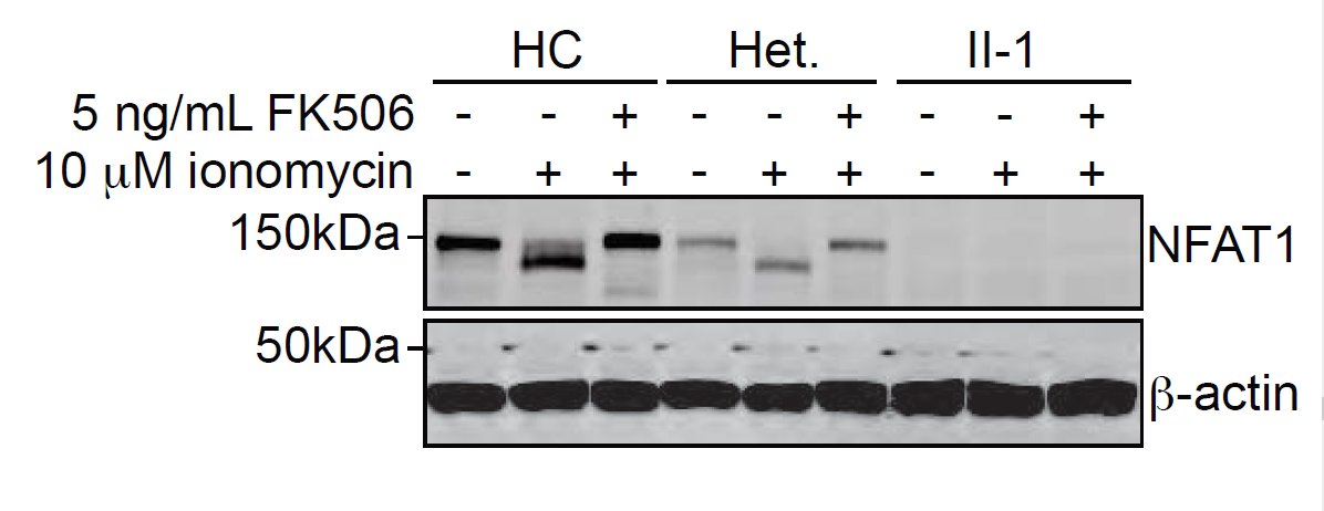 📢📢📢Just out in @BloodJournal today📢📢📢
We report the first human with complete deficiency of nuclear factor of activated T cells 1 (NFAT1).

Human complete NFAT1 deficiency causes a triad of joint contractures, osteochondromas, and B cell malignancy ashpublications.org/blood/article/…