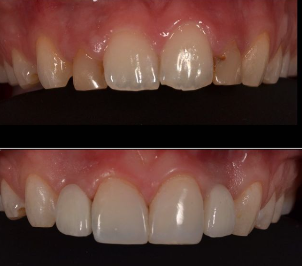 Charisma_Clinic's tweet photo. "Because of your smile, you make life more beautiful"
Smile makeover!
Want to see what we can achieve for you?
contact us Today!!
0161 483 5433- Stockport
01282690182- Nelson
 #compositebonding #veneers #whitening #braces #straightteeth #compositeveneers #bonding #cosmeticdentist https://t.co/jtMTASv80c