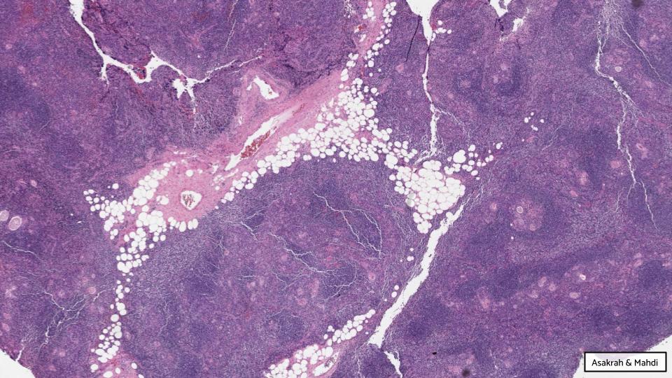 GAPathologists's tweet photo. GAP Case of the Month #12:

38♂️ w/ PMH of polymyositis, found to have an anterior mediastinal mass

By: Drs. Saja Asakrah (@SAsakrah) &amp; Zaid Mahdi (@zaid_mahdi)

📸  WSI: https://t.co/Tb9nmtNowT
💡 Answer: https://t.co/56zt9eJgaj

#GAPCoTM #thoracicpath #hemepath @EmoryPathology https://t.co/3DwxdGGYtS