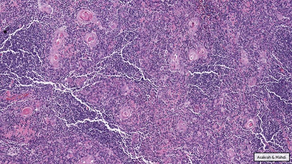 GAPathologists's tweet photo. GAP Case of the Month #12:

38♂️ w/ PMH of polymyositis, found to have an anterior mediastinal mass

By: Drs. Saja Asakrah (@SAsakrah) &amp; Zaid Mahdi (@zaid_mahdi)

📸  WSI: https://t.co/Tb9nmtNowT
💡 Answer: https://t.co/56zt9eJgaj

#GAPCoTM #thoracicpath #hemepath @EmoryPathology https://t.co/3DwxdGGYtS