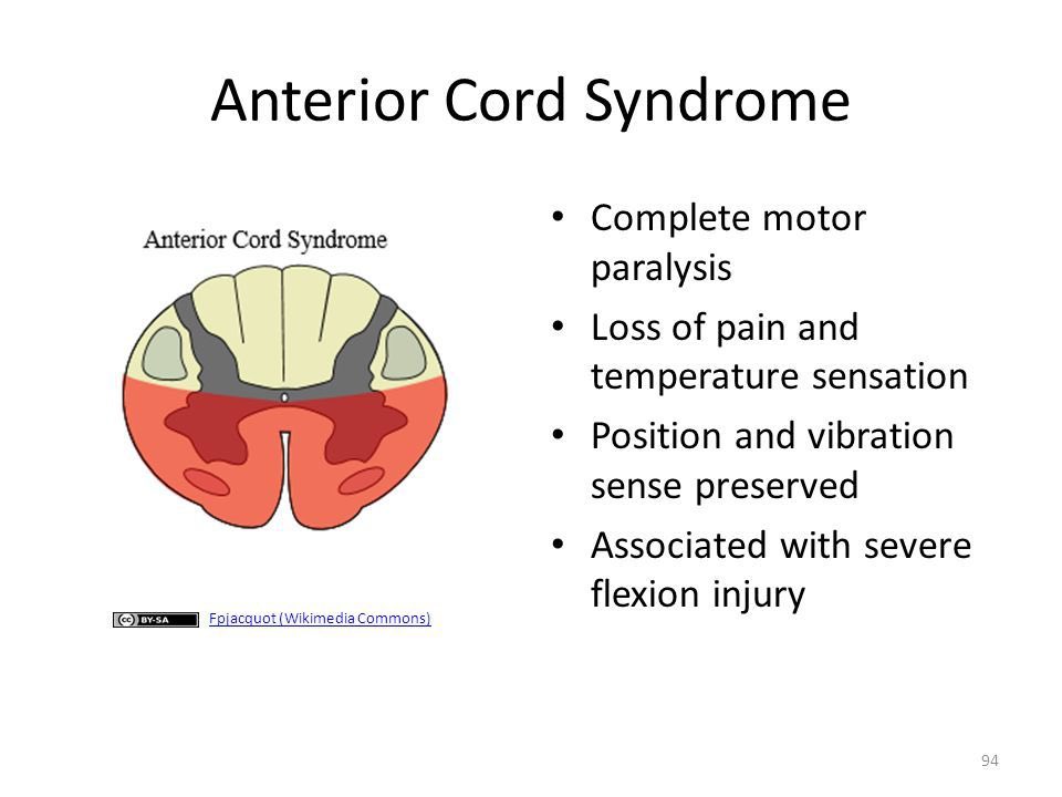 melasdpf's tweet photo. Bringing awareness to Anterior Spinal Artery Syndrome! As a survivor I am blessed to have learned to walk and do every again after my paralysis from the neck down!! #anteriorspinalarterysyndrome #blessed #medicalmystery #Godisgood https://t.co/ncpu7VZ3bW