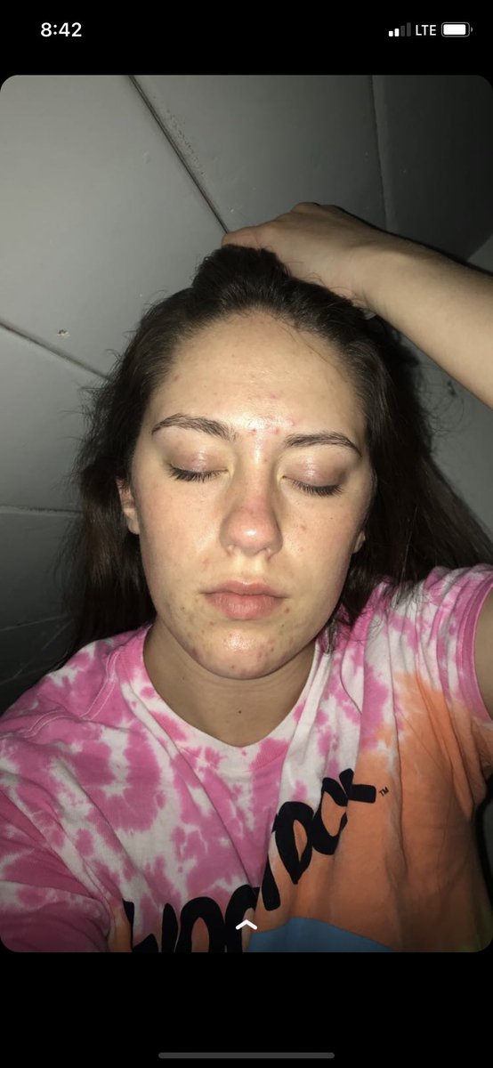 MadiPady's tweet photo. I just want to give a HUGE shoutout to @CurologyUSA, you guys have saved my skin and I could never thank you enough.. I’ve attached pictures of my before &amp; after 💜 never change, I love you 💜 https://t.co/UgFVRcarZf
