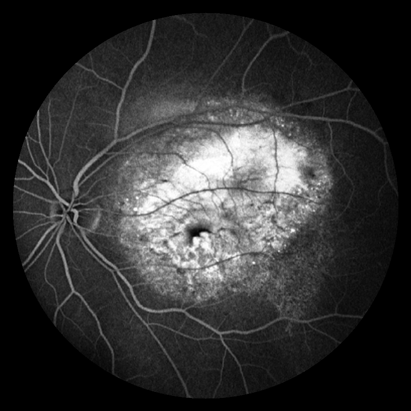 #Choroidal #osteoma is also known as choroidal osteomyeloma. Cause unknown. It is more common in healthy young females aged 20 to 30 years, and the disease is more common in one eye, but also in both eyes. #confocalretinalophthalmoscope
#funduscamera #ophthalmology #ophthalmic
