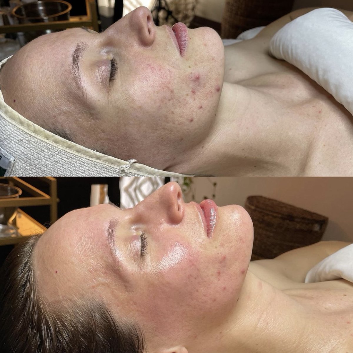 The Results 🙌 
Treat your skin to a detox with your nearest Image pro salon 🤍
#ImageSkincare #Facial #Results #SkincareResults
imageskincare.ie/find-a-pro/