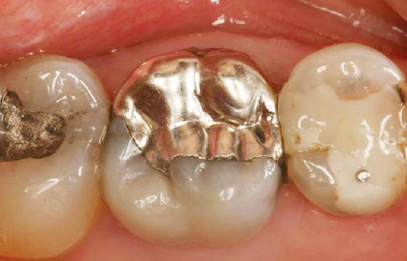 🧵AMALGAMA DENTAL
Es el material que se utiliza para reparar piezas dentales dañadas por la caries. Pueden ser de oro, cobre, estaño... la más común es de plata y en todos los casos es una aleación con MERCURIO, el metal no radiactivo más tóxico que existe.
Y es barato... ⬇️