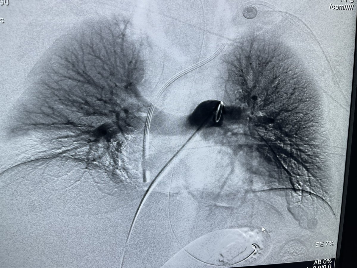 Nikolaos Ptohis (@nikolaosptohis) on Twitter photo Another great save of a 15 years old Child with massive #pulmonaryembolism . Within 60mins large amounts of clot were removed with Flowtriever <a href="/InariMedical/">Inari, now part of Stryker</a> l and vital signs immediately improved. I had the pleasure of collaborating with Prof <a href="/MakisAvgerinos/">Efthymios “Makis” Avgerinos, MD, FACS, FEBVS</a> Another great save of a 15 years old Child with massive #pulmonaryembolism . Within 60mins large amounts of clot were removed with Flowtriever <a href="/InariMedical/">Inari, now part of Stryker</a> l and vital signs immediately improved. I had the pleasure of collaborating with Prof <a href="/MakisAvgerinos/">Efthymios “Makis” Avgerinos, MD, FACS, FEBVS</a>
