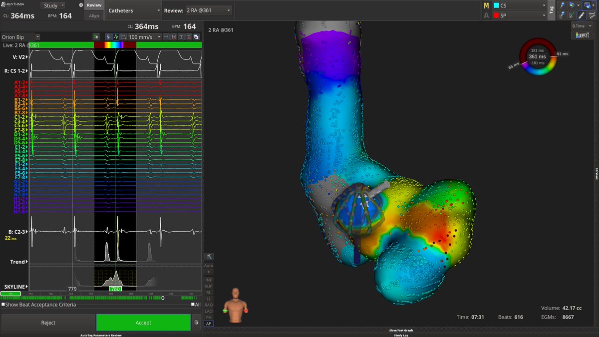 JohnPapagianni2's tweet photo. Patient with Mahaim AP
Shown are "M"potentials in sinus and during AVRT with Rhythmia system. Propagation videos will follow.@Evripidis90 https://t.co/QV51waJfdx