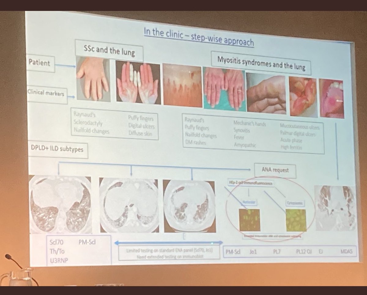 drharsha_gunawa's tweet photo. Throughly enjoyed my invitation to speak @ #BTS2022 🫁 | ☀️Manchester | rheumatology | resp  CTD ILD improving understanding and patient care. @NorthBristolNHS CTD ILD TEAM @adamalih Shaney Barratt John Pauling https://t.co/AuzIboEzVL