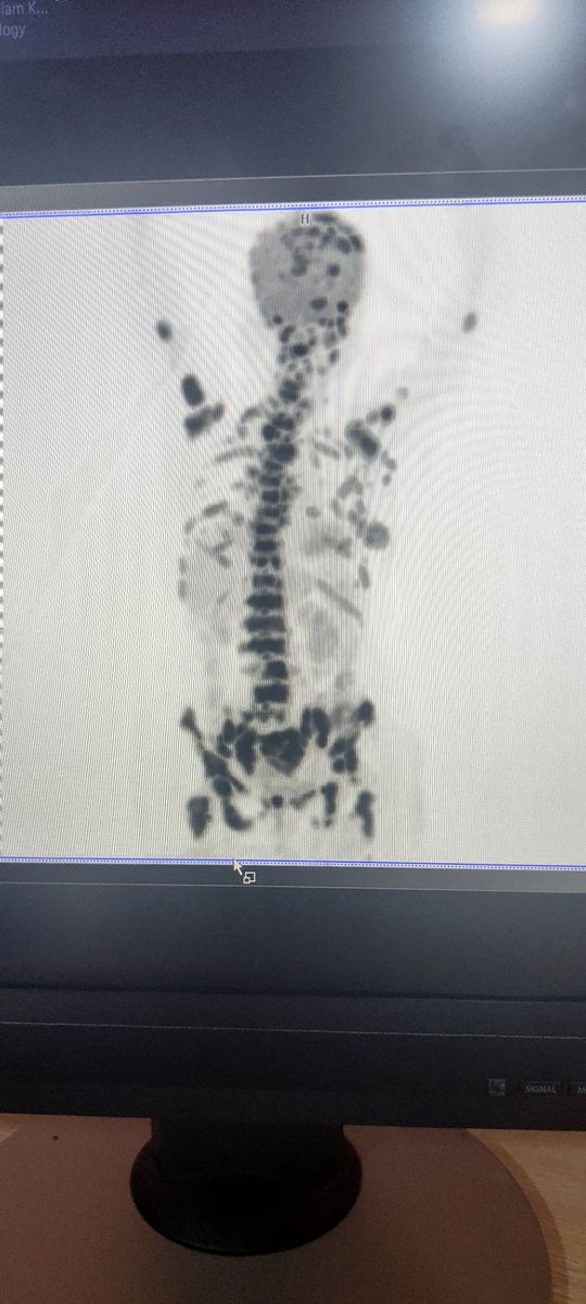 draaarkk's tweet photo. @_meen_curry Met a 60 year old patient. T2N0 ca breast. Went for ayurveda. Today presented with extensive skeletal metastases. The picture is attached. She could have easily lived a near normal life,if she had gone with her doc's advice https://t.co/ABOARIdAB9