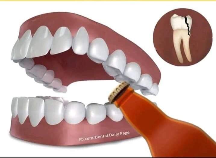 I say make I remind you that .......
Using your teeth as bottle opener, nutcracker, bone and ice crusher can cause chipping, breaking or fracture of your teeth. 

You teeth is for chewing food alone not for war! 😐😐

 #oralhealthtips #oralhealth