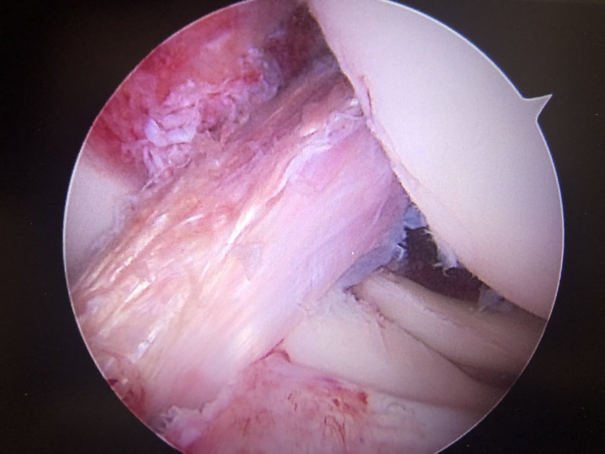 ACL Friday!
Meniscal root tears commonly occur w/ACL tears but are often missed injuries. Here is an example of a lateral root repair w/an ACL reconstruction.
#orthotwitter @MUOrthopaedic