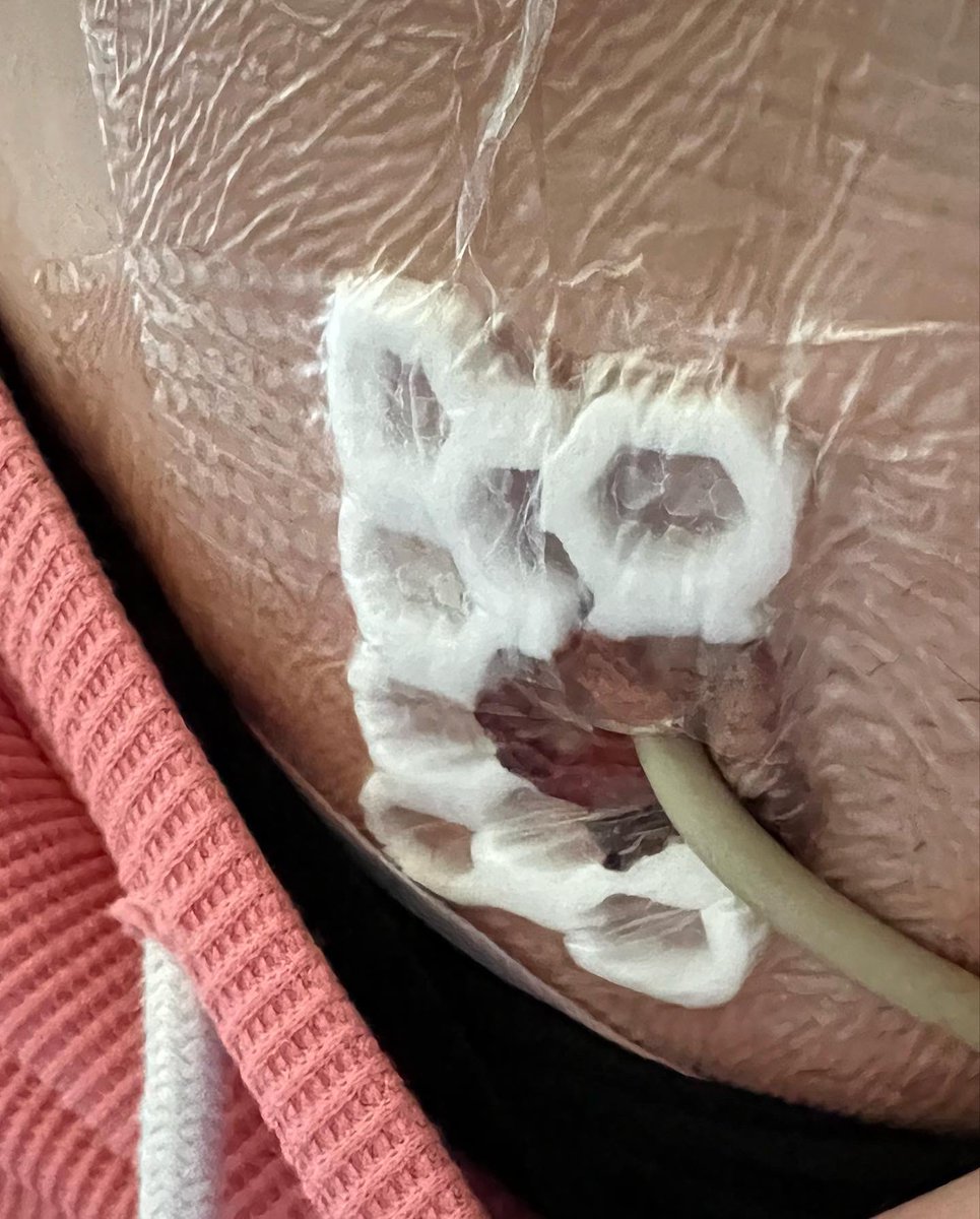 BattleWithEndo's tweet image. Yesterday I was discharged after having a surgery to form a suprapubic catheter. I was given ZERO aftercare advice. Since when is it acceptable to let patients down after having such life altering surgeries. It shouldn’t be up to us to Google our aftercare! #WomensHealthMatters