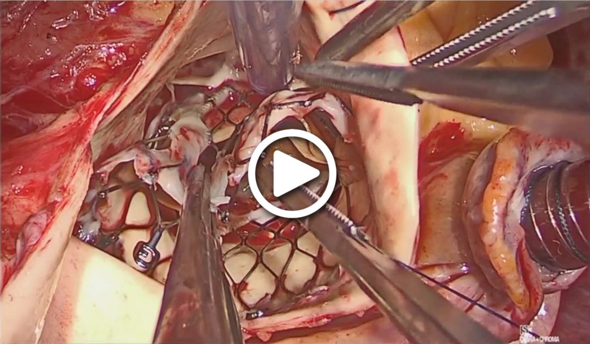 AATSJournals's tweet image. #Video Surgical Techniques for Removal and Replacement of Chronically Implanted TAVR Prosthesis. By von Ballmoos, Reardon, et al. in OpTechs. Watch the video here: bit.ly/3unPvMb Article available here: doi.org/10.1053/j.opte… #JTCVS #CardioTwitter @tssmn @OPreventzaMD